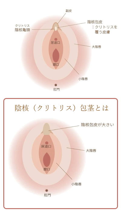 クリトリス包茎手術