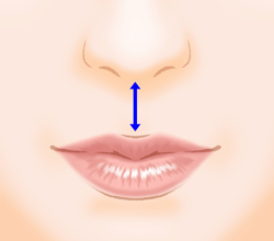 上口唇短縮術（人中短縮・リップリフト）の施術プロセス その1