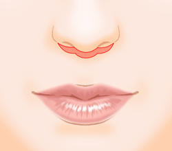 上口唇短縮術（人中短縮・リップリフト）の施術プロセス その2