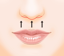 上口唇短縮術（人中短縮・リップリフト）の施術プロセス その3