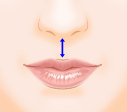 上口唇短縮術（人中短縮・リップリフト）の施術プロセス その4