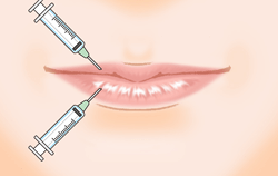 唇へのヒアルロン酸注入の施術プロセス その2