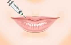 唇へのヒアルロン酸注入の施術プロセス その4