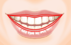 口唇縮小術の施術プロセス その1