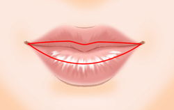口唇縮小術の施術プロセス その2