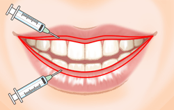 口唇縮小術の施術プロセス その3