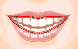 口唇縮小術の施術プロセス その5