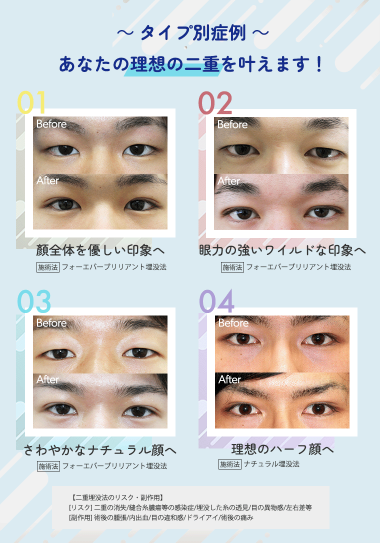 タイプ別症例 理想の二重を叶えます