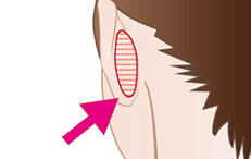 鼻中隔延長術の施術プロセス その3