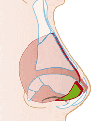 鼻中隔延長術の施術プロセス その3