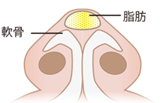 鼻尖縮小術の施術プロセス その2