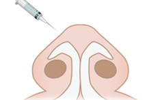 鼻尖縮小術の施術プロセス その3