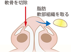 鼻尖縮小術の施術プロセス その4