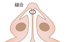 鼻尖縮小術の施術プロセス その5