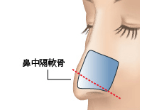 鼻中隔軟骨切除のプロセス 埋没法 正面1