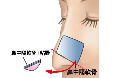 鼻中隔軟骨切除のプロセス 埋没法 正面2