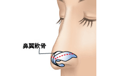 鼻翼軟骨切除のプロセス 埋没法 正面1