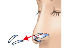 鼻翼軟骨切除のプロセス 埋没法 正面2