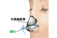 鼻翼軟骨切除のプロセス 埋没法 正面3