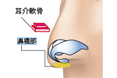 鼻橋部軟骨移植のプロセス 埋没法 正面1