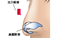 鼻尖部軟骨移植のプロセス 埋没法 正面1