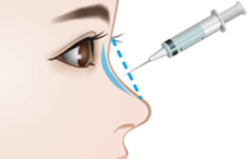 隆鼻注射（レディエッセ）の施術プロセス その4