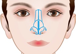 斜鼻修正の施術プロセス その3