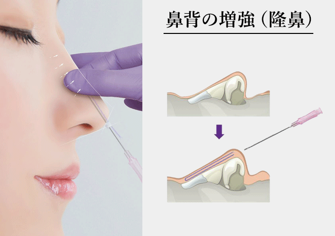 鼻背の増強（隆鼻術）