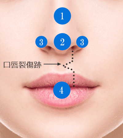 口唇裂修正の治療部位と施術方法