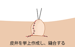 へそ形成の施術プロセス その3