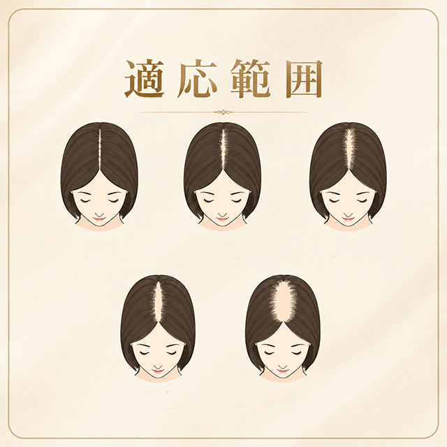 VFD毛髪再生治療の適応範囲