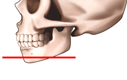 アゴ形成術（オトガイ骨切り前方移動術）の施術プロセス その2