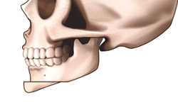 アゴ形成術（オトガイ骨切り前方移動術）の施術プロセス その3