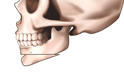 アゴ縮小術（オトガイ骨切り後方移動術）の施術プロセス その3