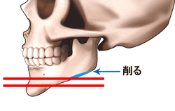 アゴ縮小術（オトガイ骨切り・骨抜き術）の施術プロセス その2