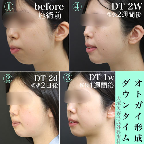 オトガイ骨切りのダウンタイムの経過