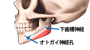 エラ骨切りのプロセス 横向き1