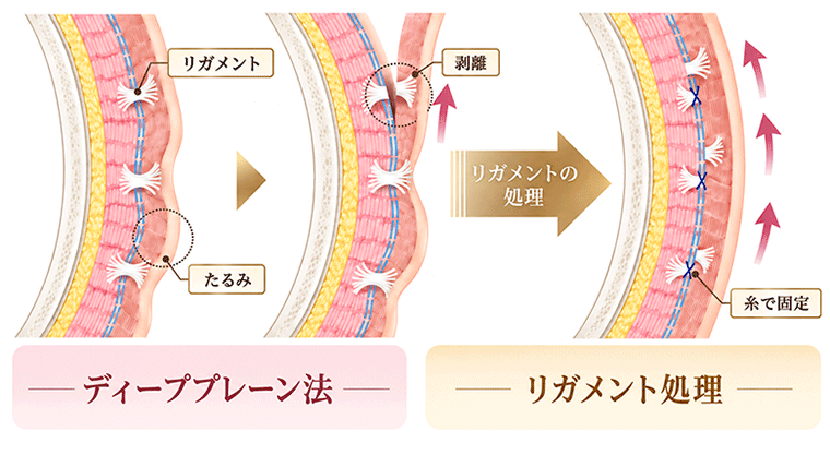 リガメント＋ディーププレーン法