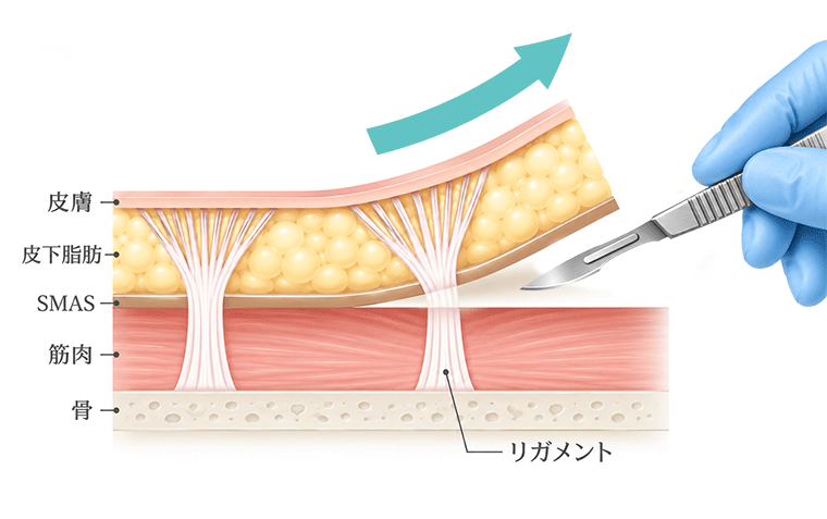 フェイスリフトとは