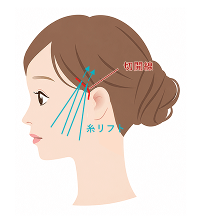ミニリフト
