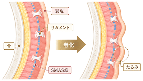 たるみの構造