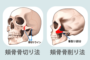 頬骨削りとは 頬骨骨切り法 頬骨骨削り法