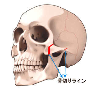 骨切り術のプロセス 斜め1