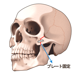 骨切り術のプロセス 斜め2