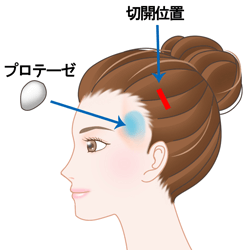 こめかみ形成術（プロテーゼ挿入）の施術プロセス その2