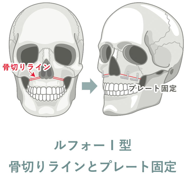 ルフォーⅠ型骨切り術（上顎骨切り術）とは上顎全体の移動を行う輪郭形成術です