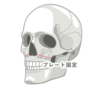 ルフォーⅠ型骨切り術　固定