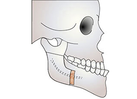 下顎枝矢状分割術　骨の移動