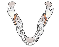 下顎枝矢状分割術　骨の移動