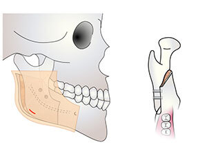 下顎枝矢状分割術　固定